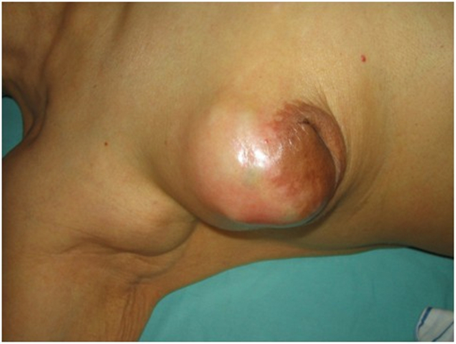 女性乳腺癌表现图片