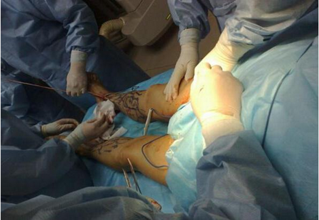 下肢静脉曲张患者手术图片