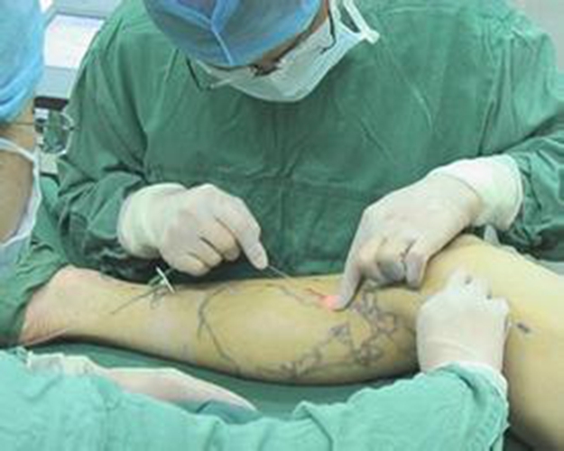 下肢静脉曲张图片患者进行手术图片