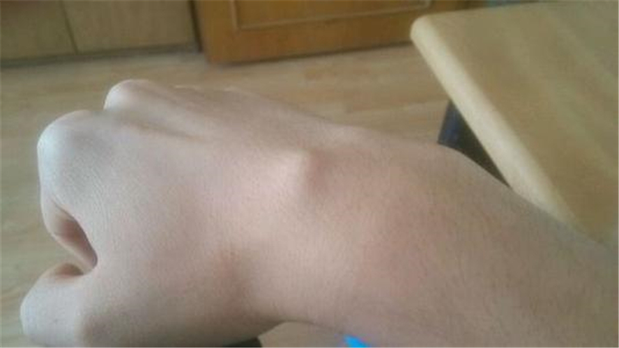 手腕腱鞘炎 初期图片