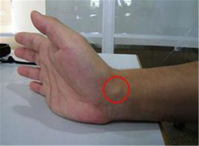 手腕腱鞘炎在哪个位置图片