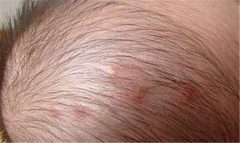 4个月婴儿毛囊炎图片图片