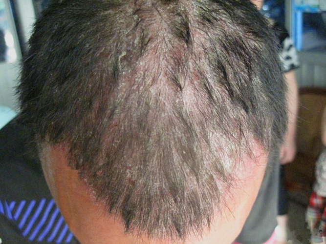 头皮癣症状早期图片