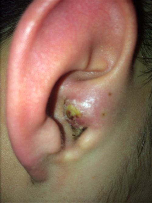 外耳道疱疹图片图片