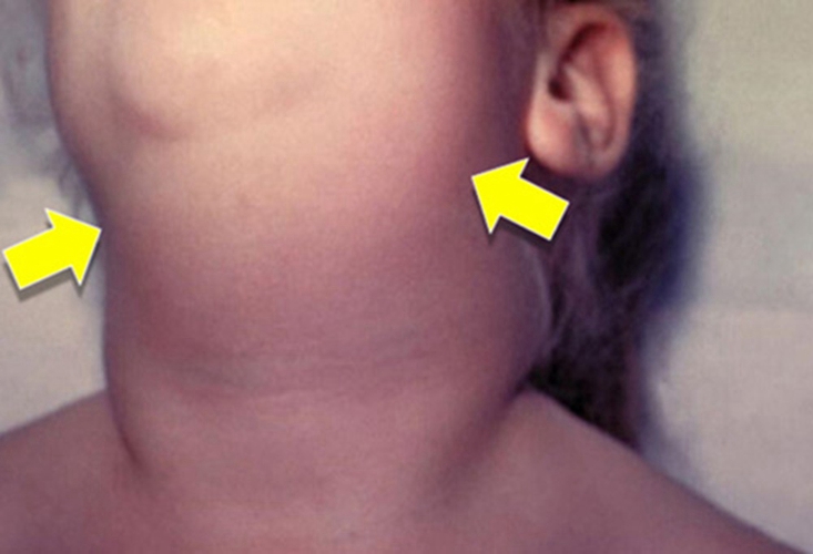 小儿腮腺炎早期图片图片