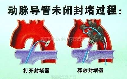 下面分别是动脉导管未闭,房间隔缺损,室间隔缺损的介入封堵示意图