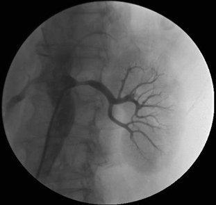 肾动脉狭窄造影表现