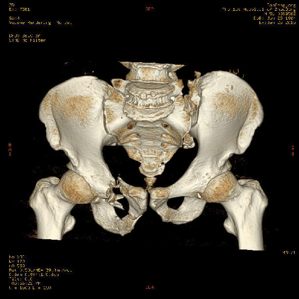 骨盆c型骨折骶髂螺钉微创内固定