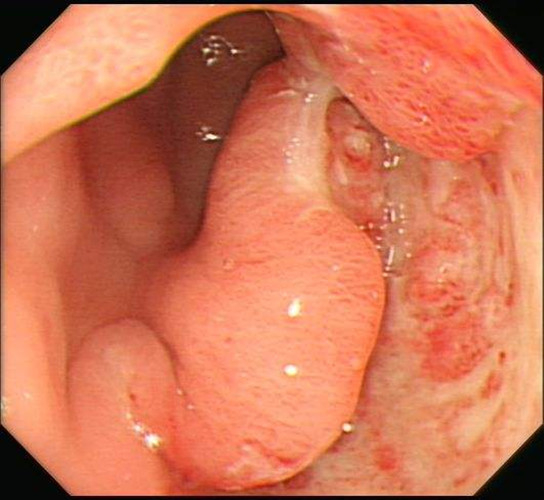 慢性胃炎前期的图片