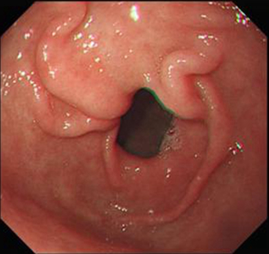 慢性浅表性胃炎蠕动图片