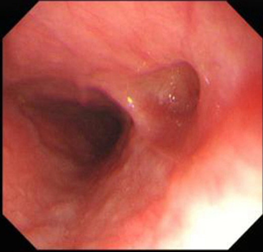 慢性浅表性胃炎伴溃疡孔图片