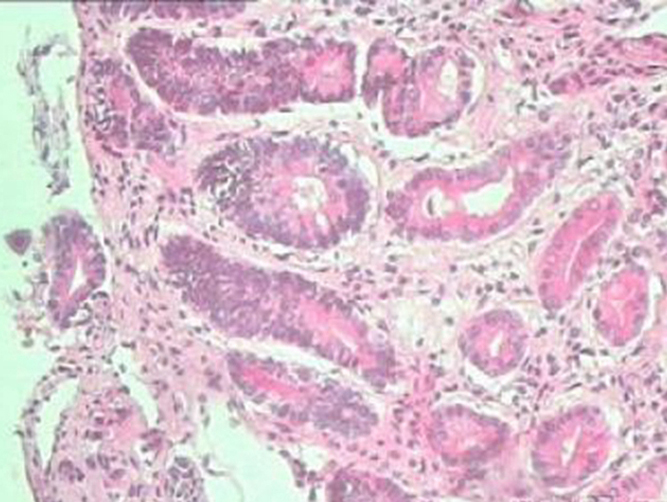 慢性浅表性胃炎病理细胞图片