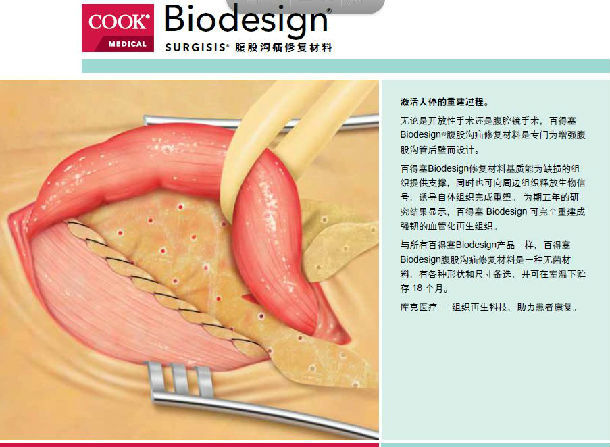 青少年(8岁以上)腹股沟疝生物补片修补手术