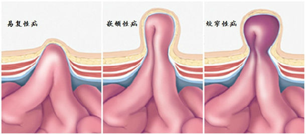 (疝气的嵌顿和绞窄)腹股沟疝最大的危险是急性嵌顿,多见于突然的咳嗽