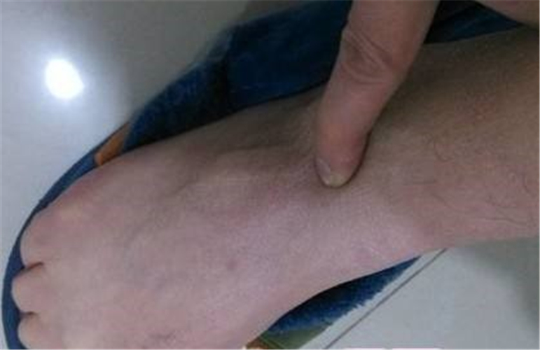女性足部腱鞘炎图片