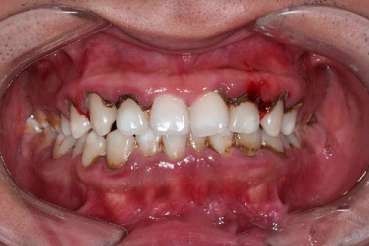 牙周病晚期图片图片