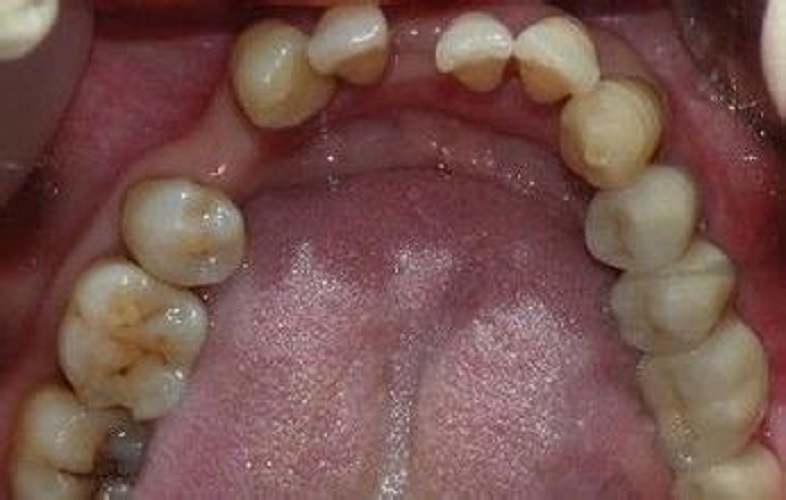 慢性牙周炎比较严重图片