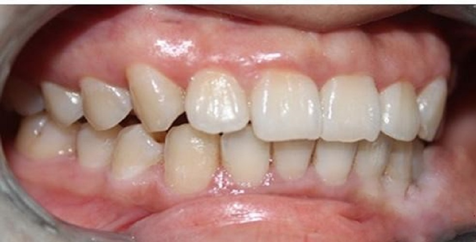 慢性牙周炎病例图片