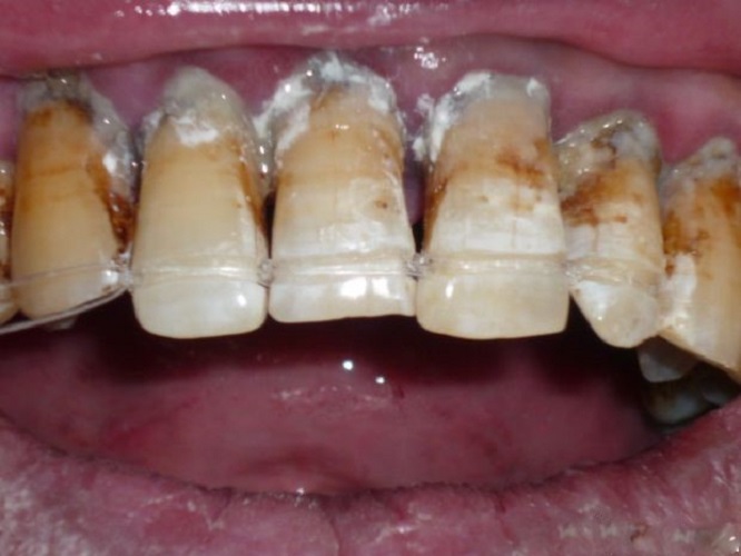慢性牙周炎治疗图片