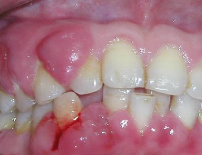 慢性牙周炎重症患者图片