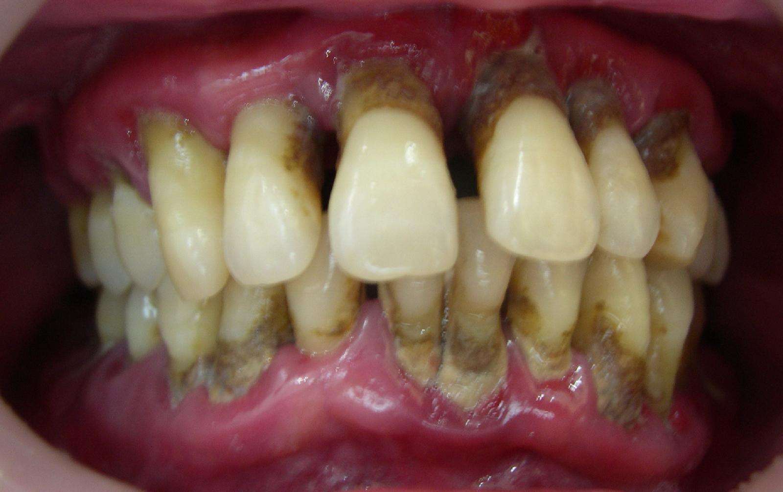 严重的慢性牙周炎图片