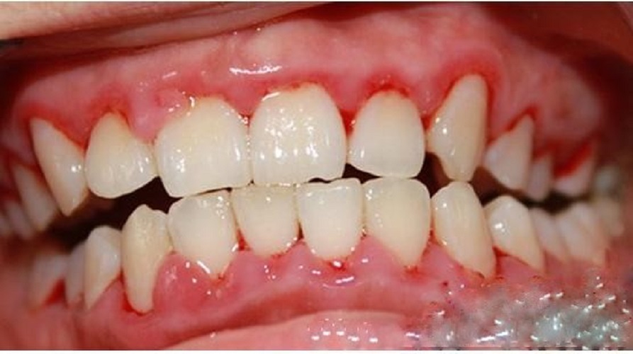 一列慢性牙周炎图片