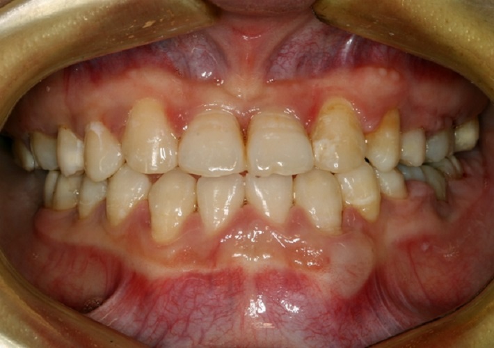 中年慢性牙周炎图片