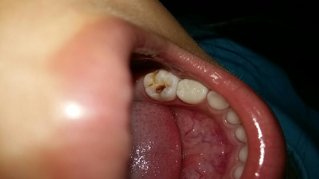 初期的慢性牙髓炎的图片