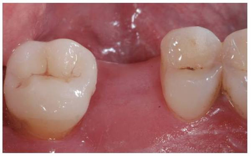 初期慢性牙髓炎治疗图片