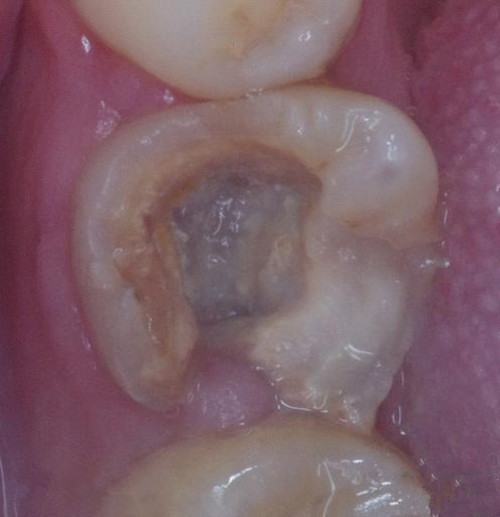 口腔慢性牙髓炎深龋图片