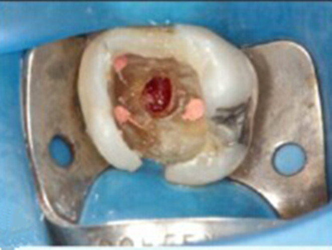 慢性牙髓炎中图图片