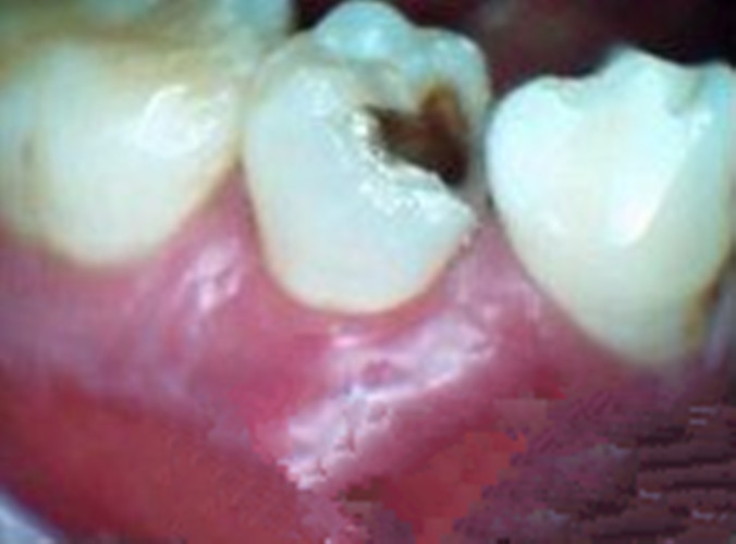 慢性牙髓炎治疗图片