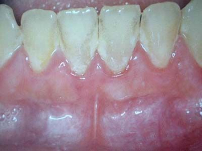 慢性牙髓炎脓肿的口腔图片