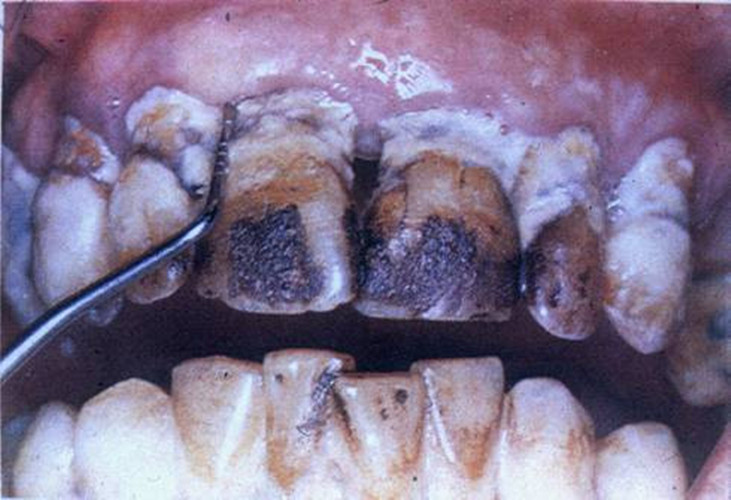 慢性牙髓炎可复性图片 