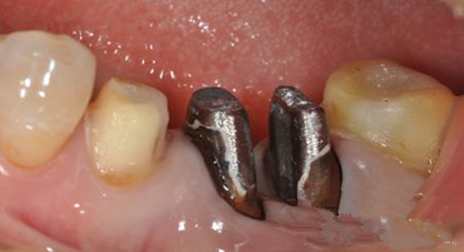 慢性牙髓炎结束治疗图片