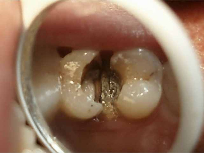 慢性牙髓炎图片