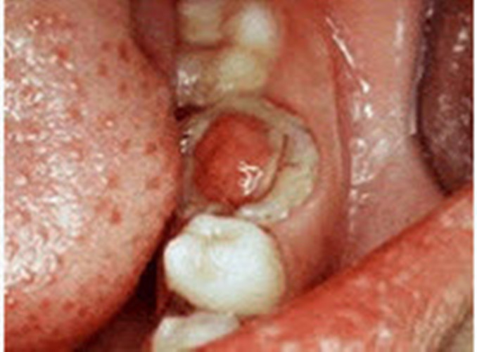 慢性牙髓炎息肉图片