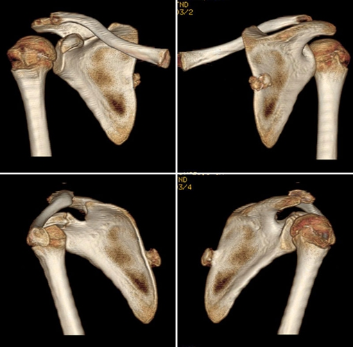 肩胛骨内生软骨瘤特征图片