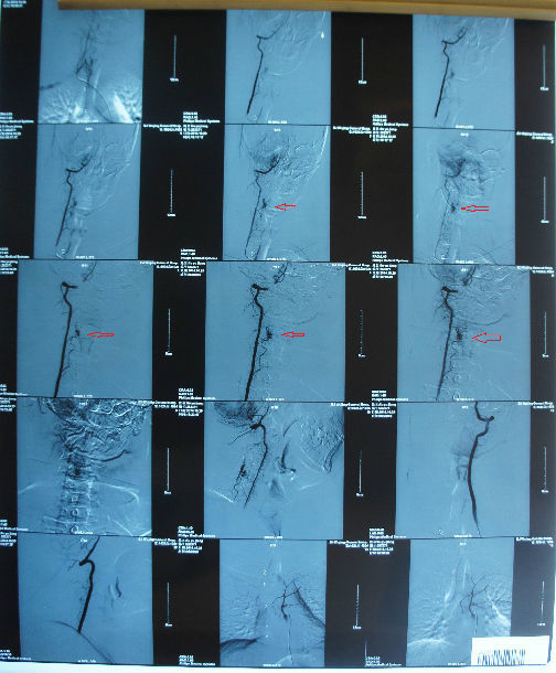 术前脊髓造影影像(动静脉畸形见红色箭头)