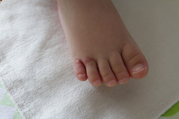 婴儿脚趾并指图图片