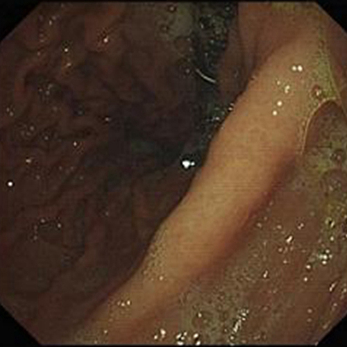 慢性浅表性胃炎1级图片