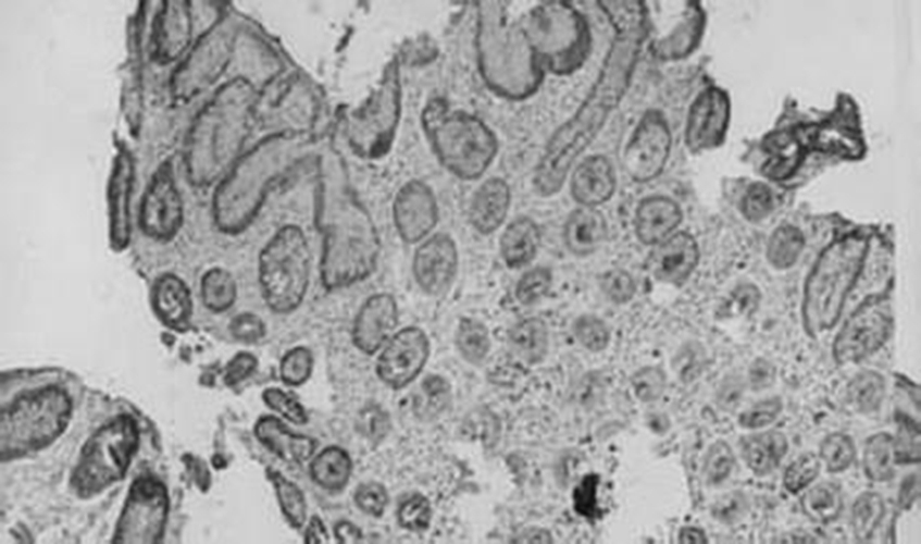 慢性浅表性胃炎并溃疡病理细胞图片