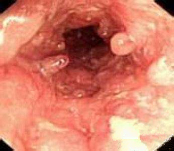 慢性肠炎的内窥镜图片