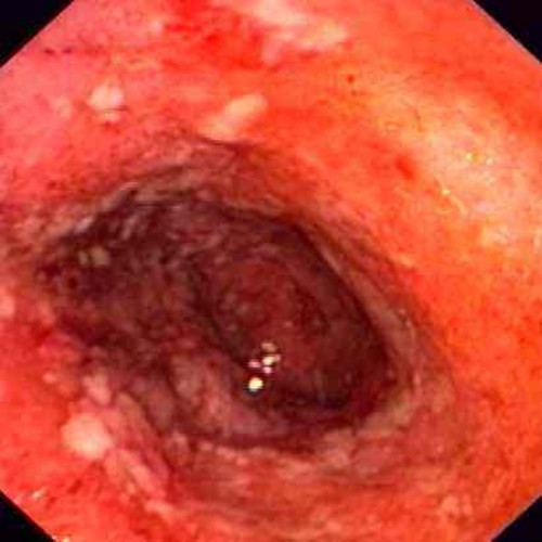 慢性肠炎结肠段图片