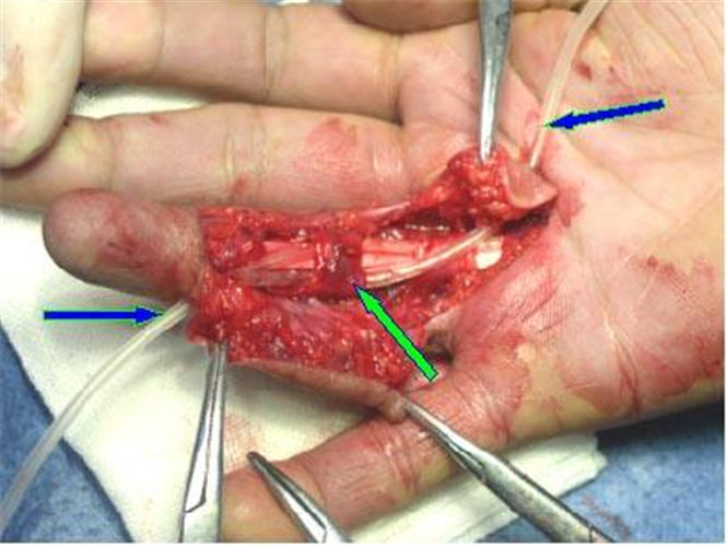急性化脓性腱鞘炎图片图片