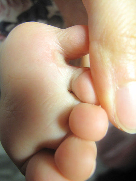 并趾手术不宜迟