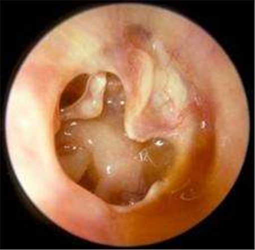 急性中耳炎的鼓膜图片