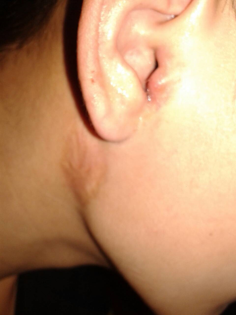 初期急性中耳炎图片