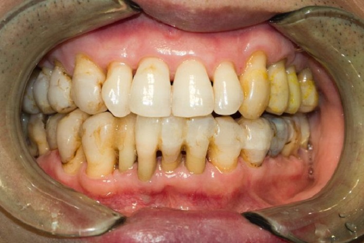 患者慢性牙周炎图片