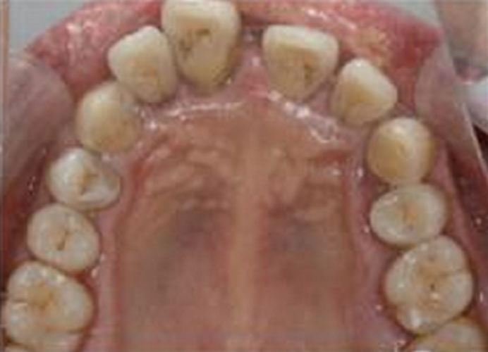 慢性牙周炎表征图片